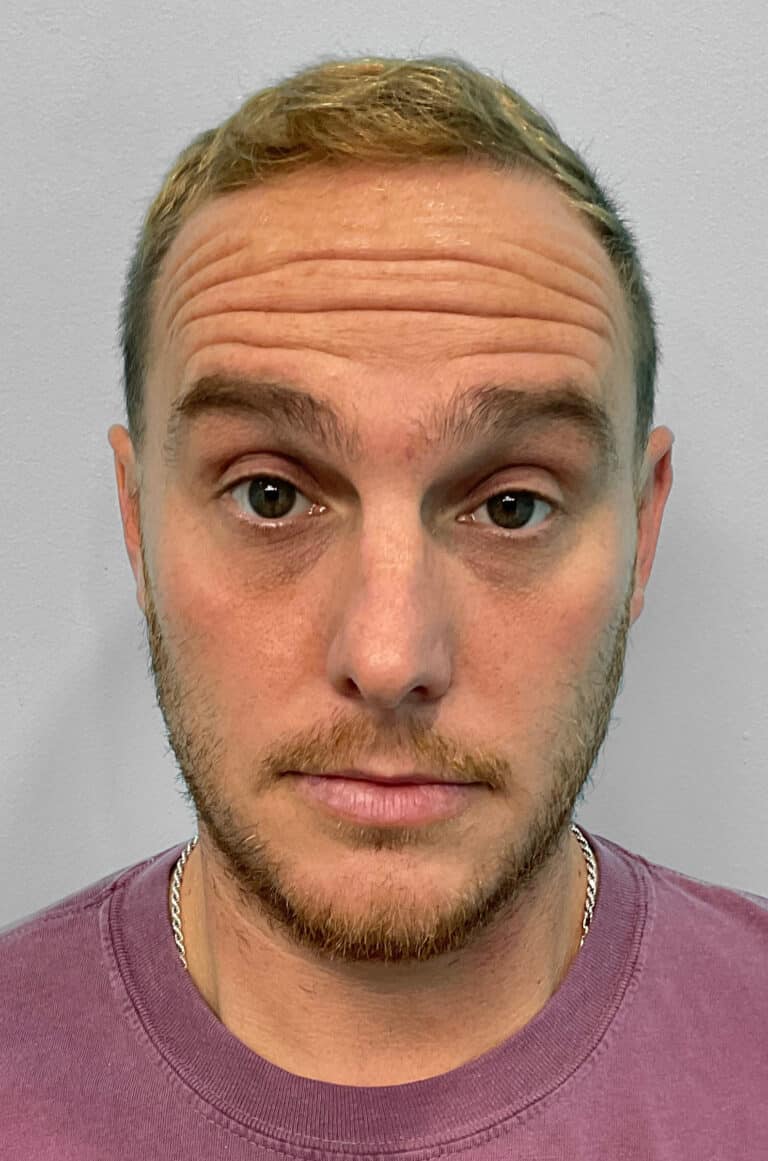 Before Image: Botox- Joy -
