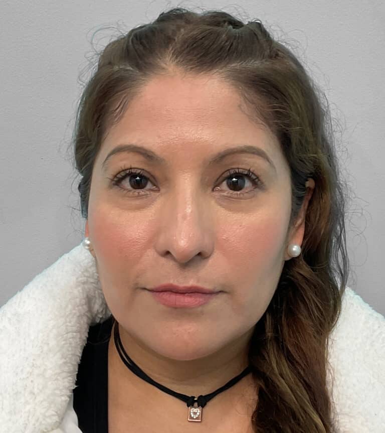 Before Image: Juvéderm Voluma- Joy - front