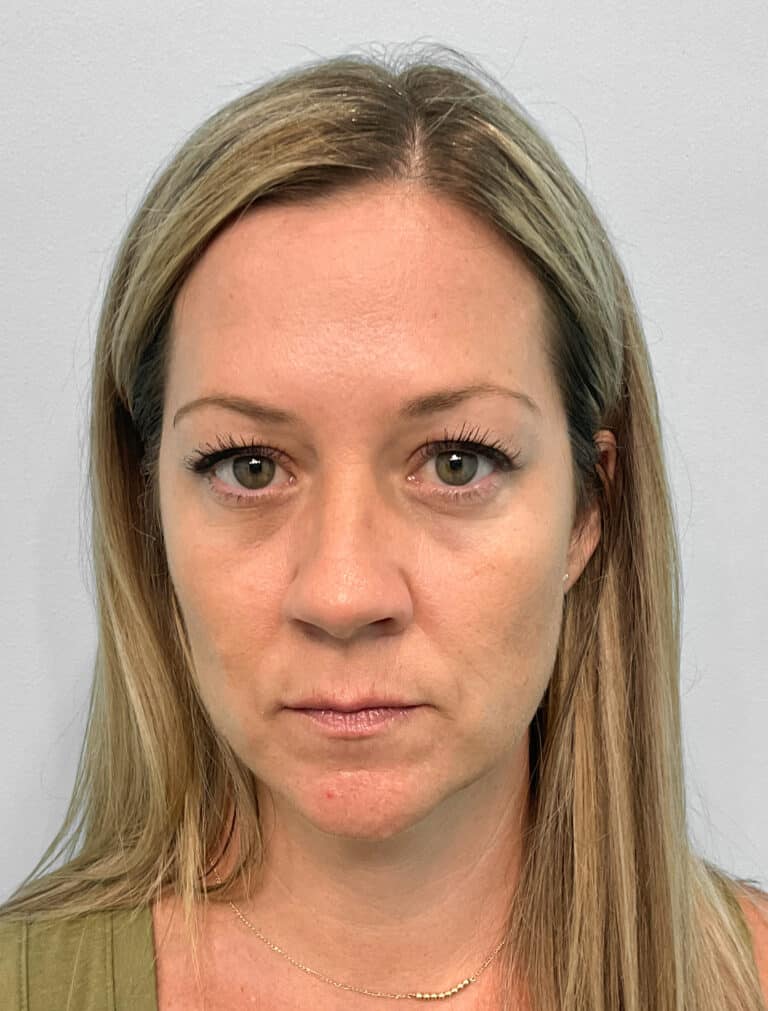 Before Image: Juvéderm Volbella & Botox- Joy - front