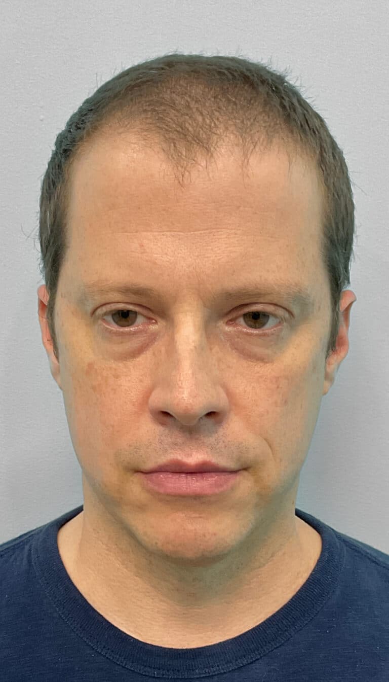 Before Image: Botox- Joy - front