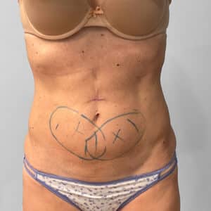 Coolsculpting- Jessica