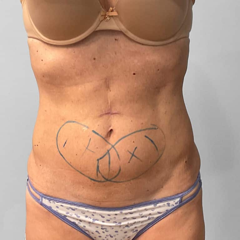 Before Image: Coolsculpting- Jessica - front