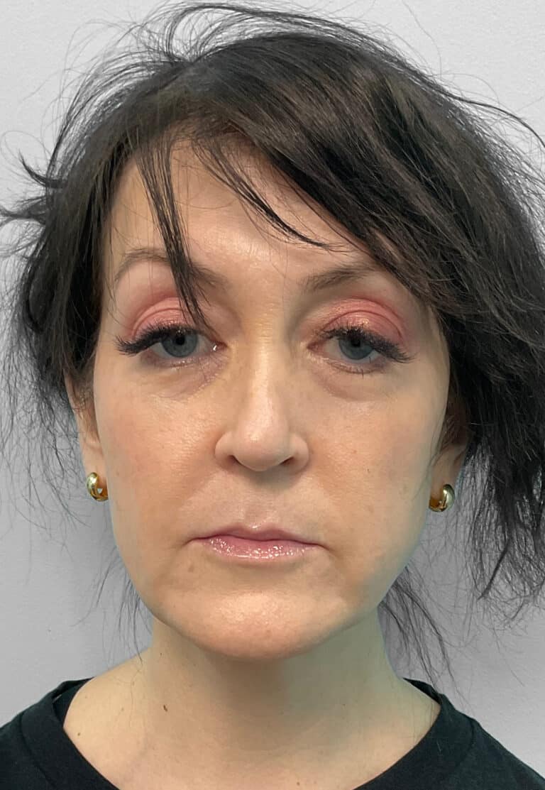 Before Image: Juvéderm Ultra, Voluma, & Botox- Joy - front