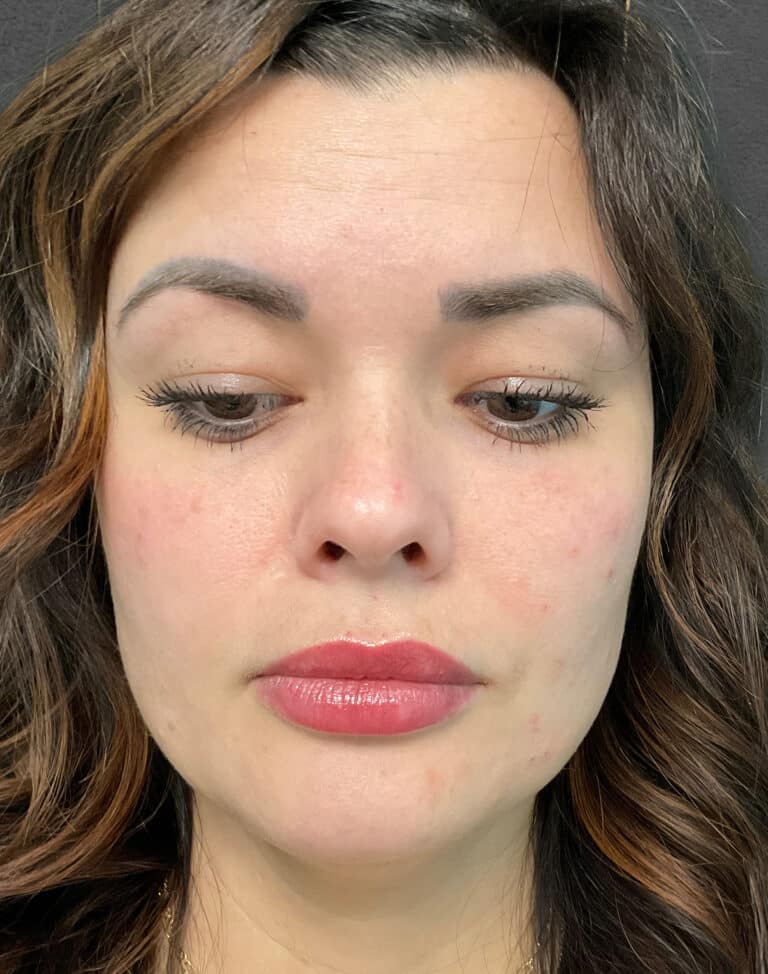 Before Image: Juvéderm Ultra & Voluma- Heather - front