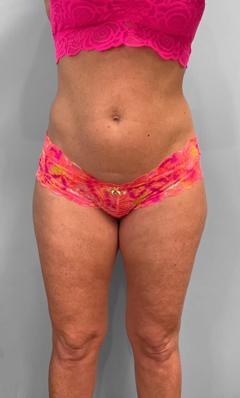 Before Image: Emsculpt Neo- Jessica - front