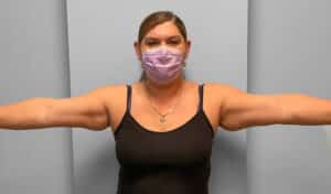Before Image: Coolsculpting- Jessica