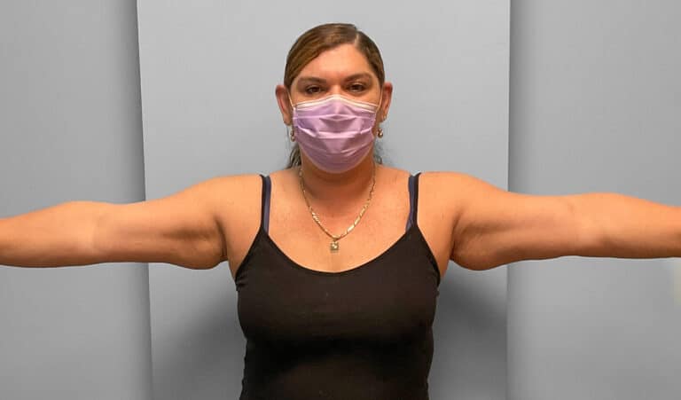 Before Image: Coolsculpting- Jessica - front