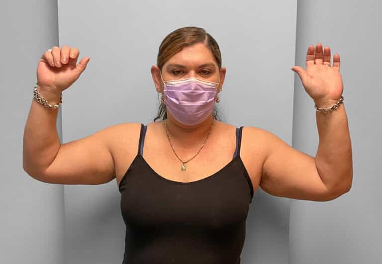 Before Image: Coolsculpting- Jessica - front