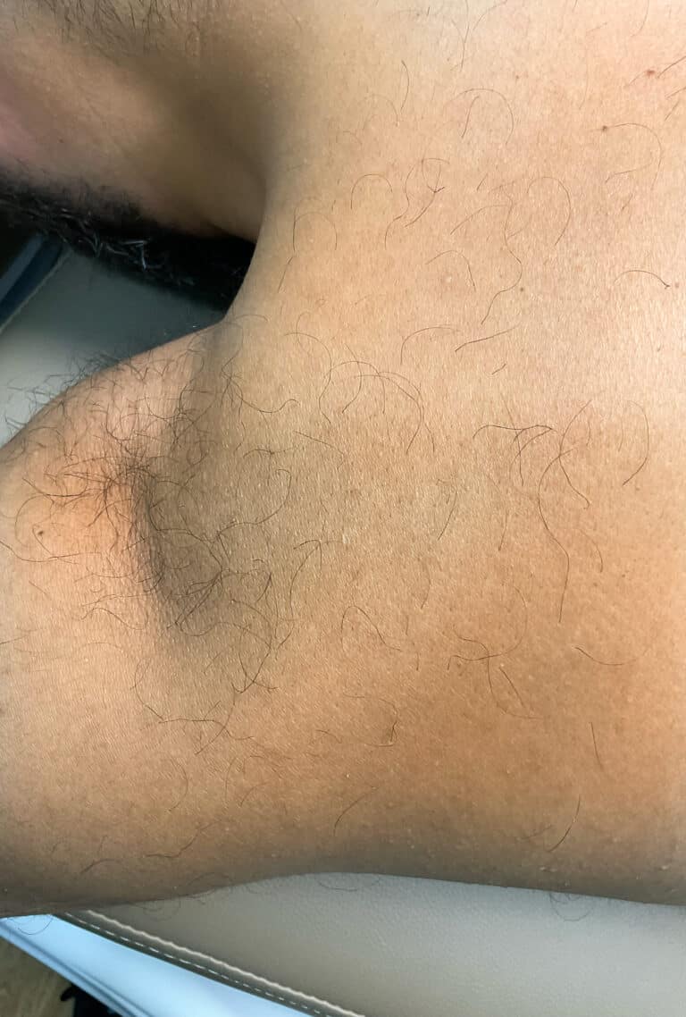Before Image: Laser Hair Removal- Jade - left-side