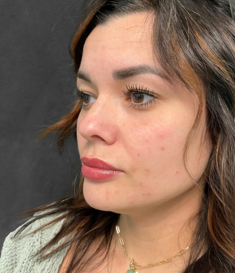 Before Image: Juvéderm Ultra & Voluma- Heather - left-front-oblique