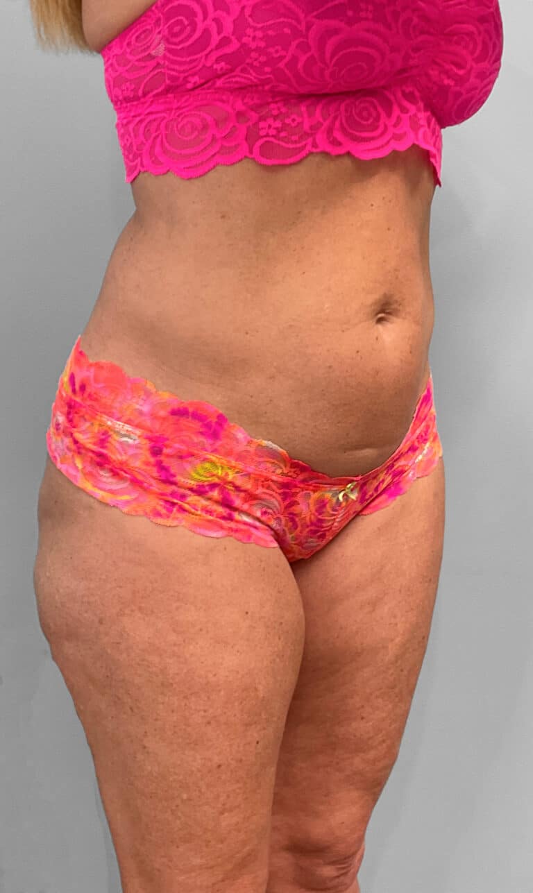 Before Image: Emsculpt Neo- Jessica - right-front-oblique