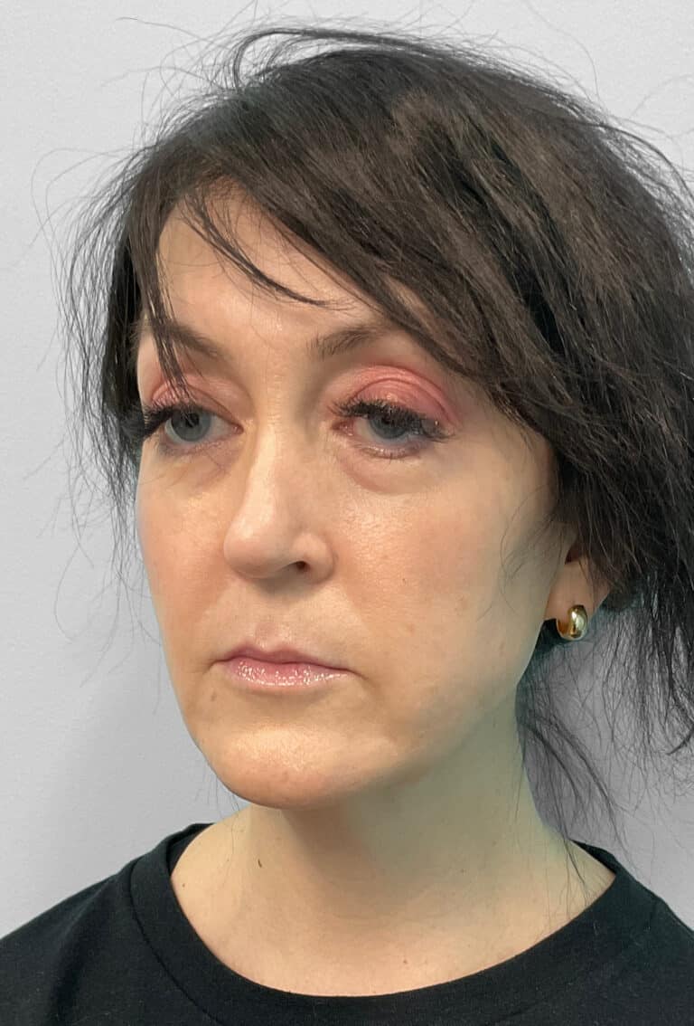 Before Image: Juvéderm Ultra, Voluma, & Botox- Joy - left-front-oblique