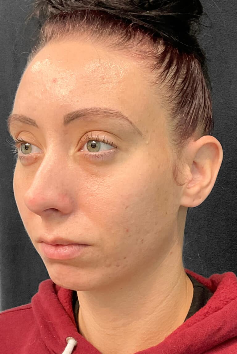 Before Image: Juvéderm Voluma- Joy -