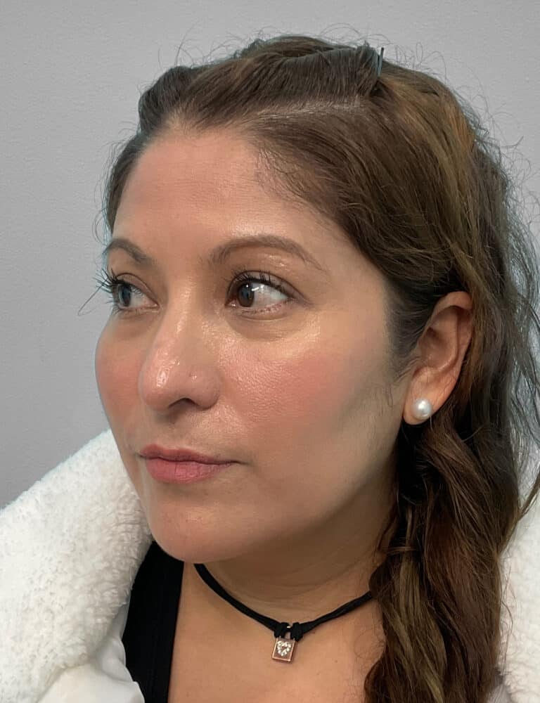 Before Image: Juvéderm Voluma- Joy - left-front-oblique