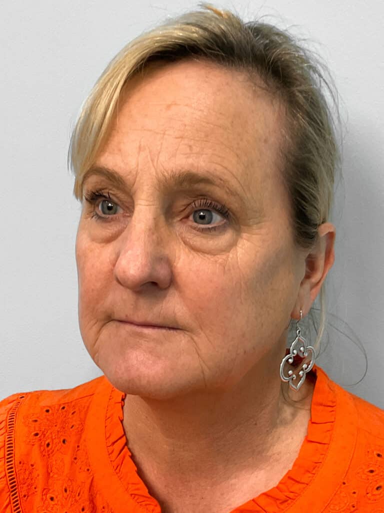 Before Image: Juvéderm Voluma- Joy - left-front-oblique
