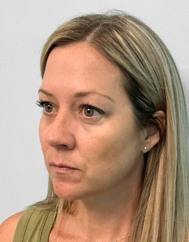 Before Image: Juvéderm Volbella & Botox- Joy - left-front-oblique
