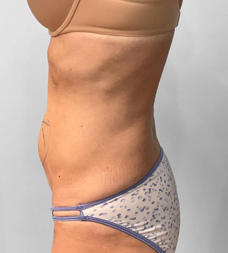 Before Image: Coolsculpting- Jessica - left-side