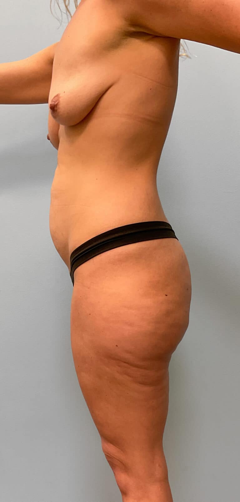 Before Image: Mommy Makeover- Dr. Howell - left-side