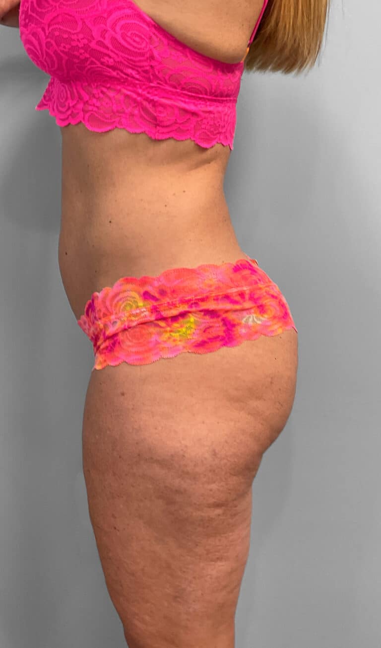 Before Image: Emsculpt Neo- Jessica - left-side