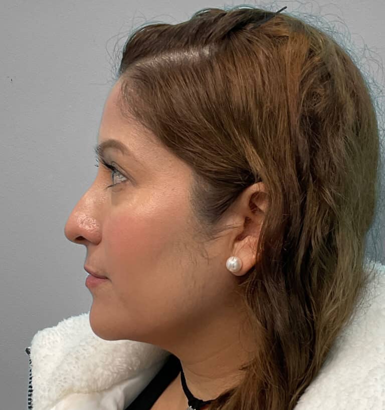 Before Image: Juvéderm Voluma- Joy - left-side