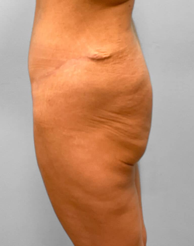 Before Image: Body Lift – Dr. Howell - left-side