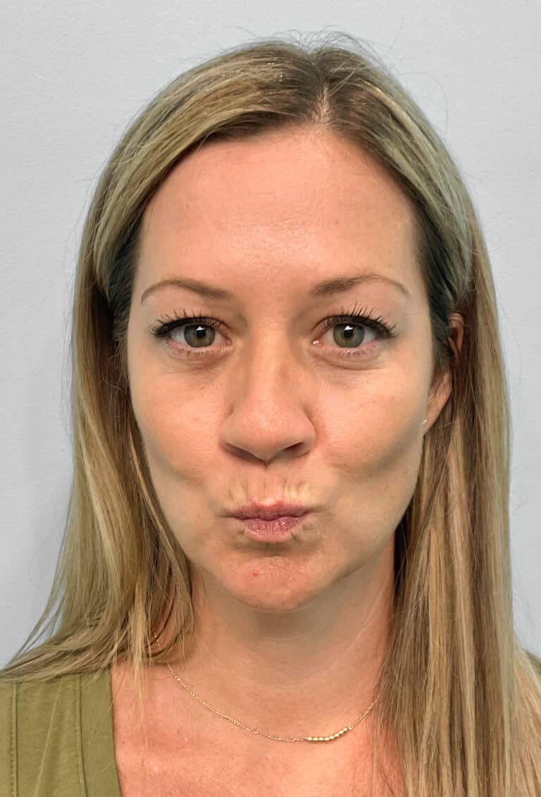 Before Image: Juvéderm Volbella & Botox- Joy - front