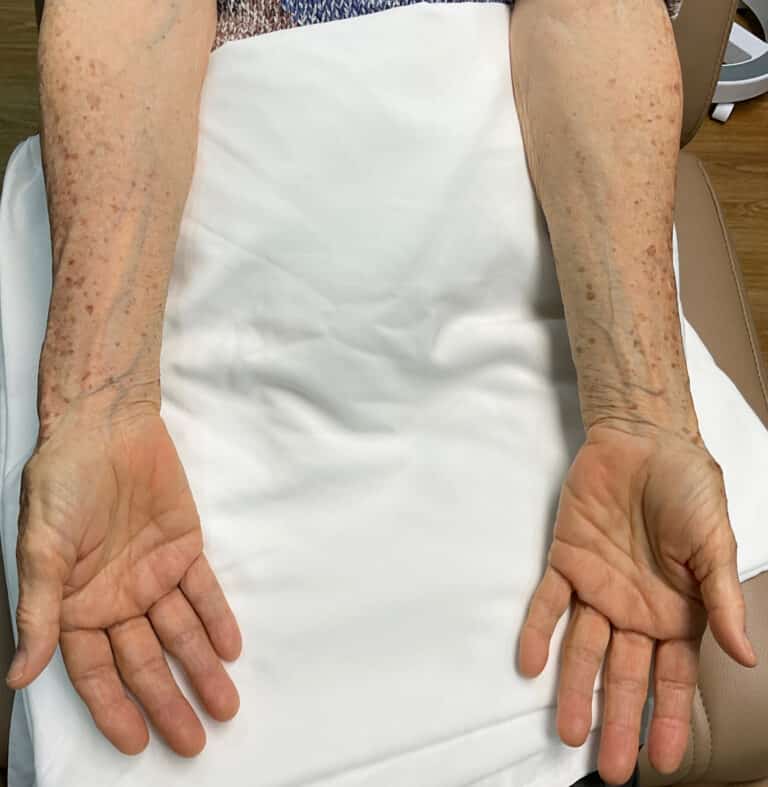 Before Image: Laser Treatment- Jade - back