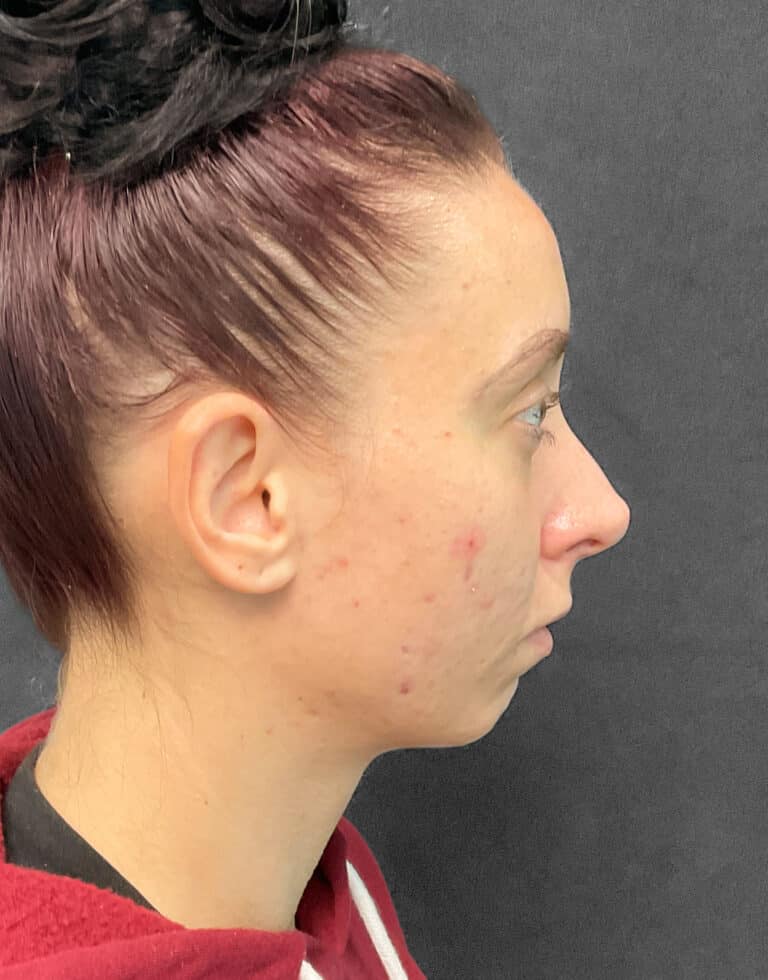 Before Image: Juvéderm Voluma- Joy - right-side