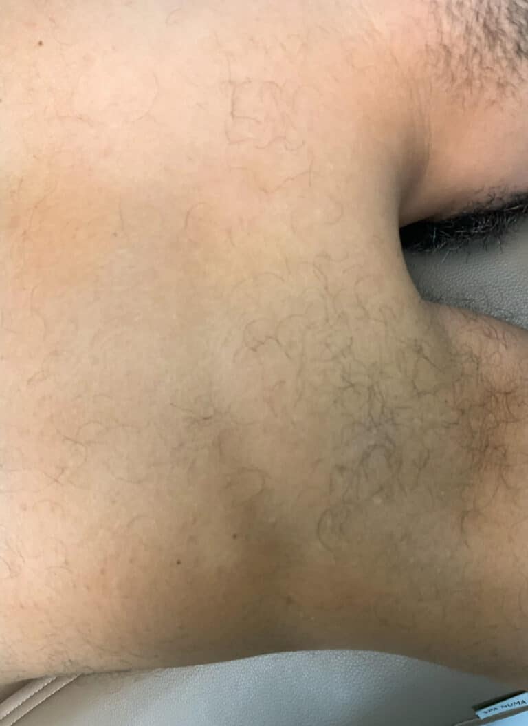 Before Image: Laser Hair Removal- Jade - right-side
