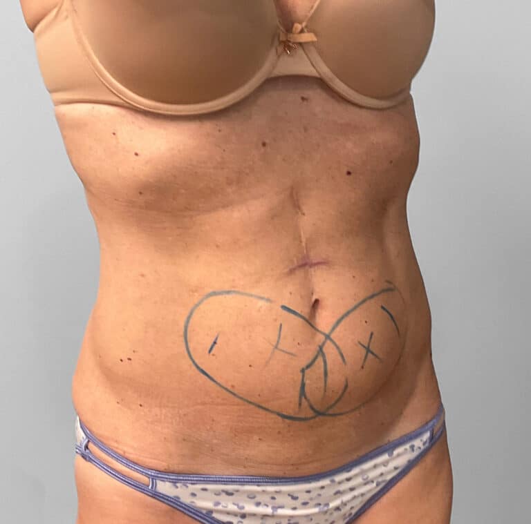 Before Image: Coolsculpting- Jessica - right-front-oblique