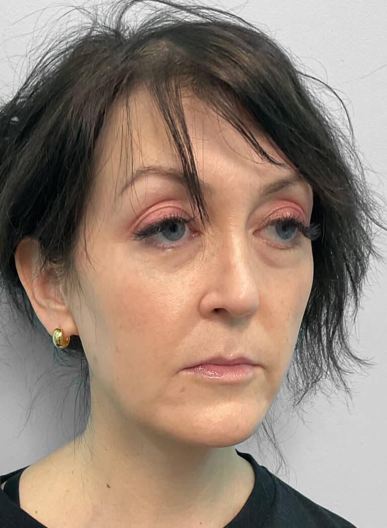 Before Image: Juvéderm Ultra, Voluma, & Botox- Joy - right-front-oblique