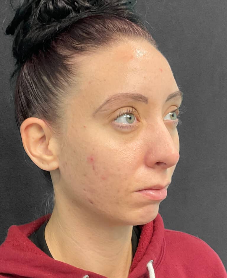 Before Image: Juvéderm Voluma- Joy - right-front-oblique