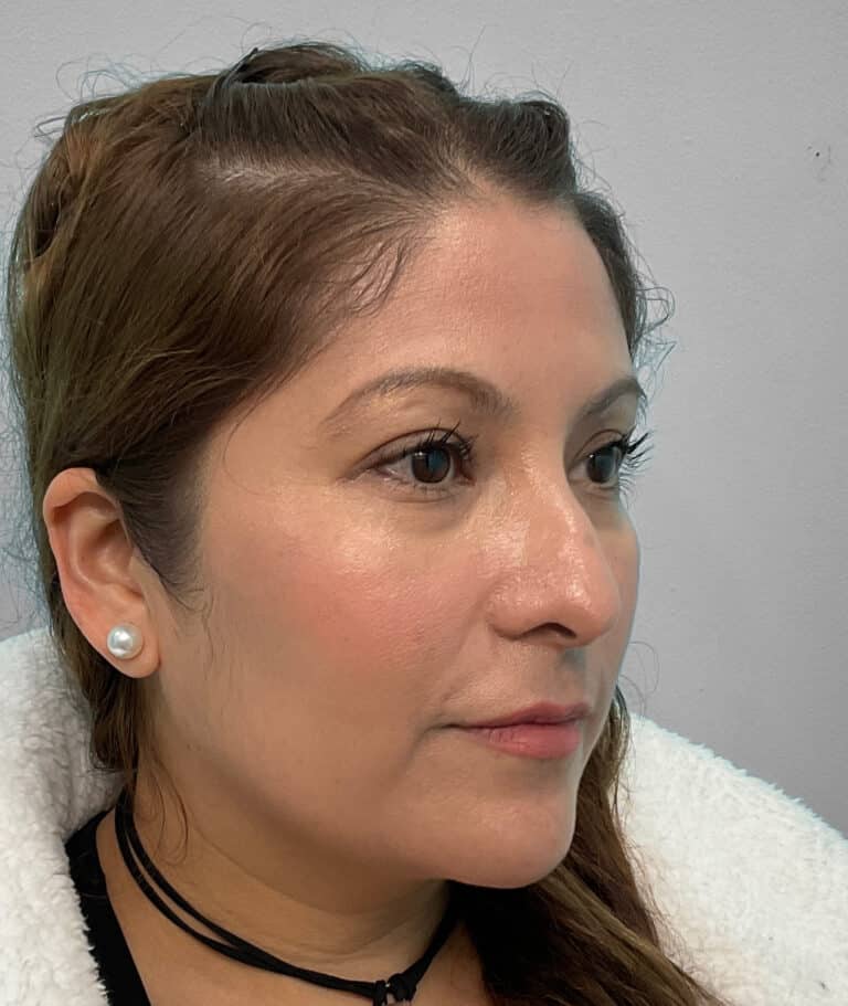 Before Image: Juvéderm Voluma- Joy - right-front-oblique