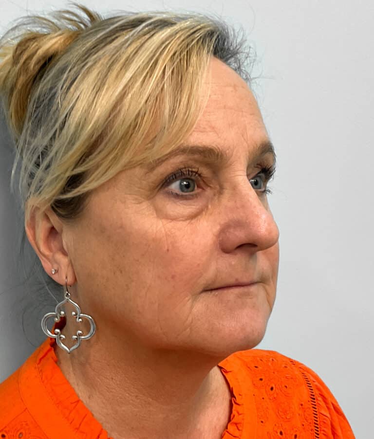 Before Image: Juvéderm Voluma- Joy - right-front-oblique