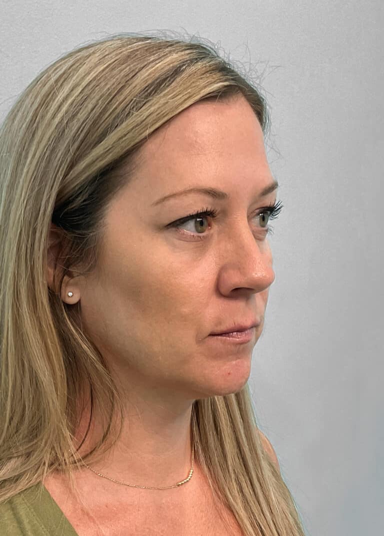 Before Image: Juvéderm Volbella & Botox- Joy - right-front-oblique