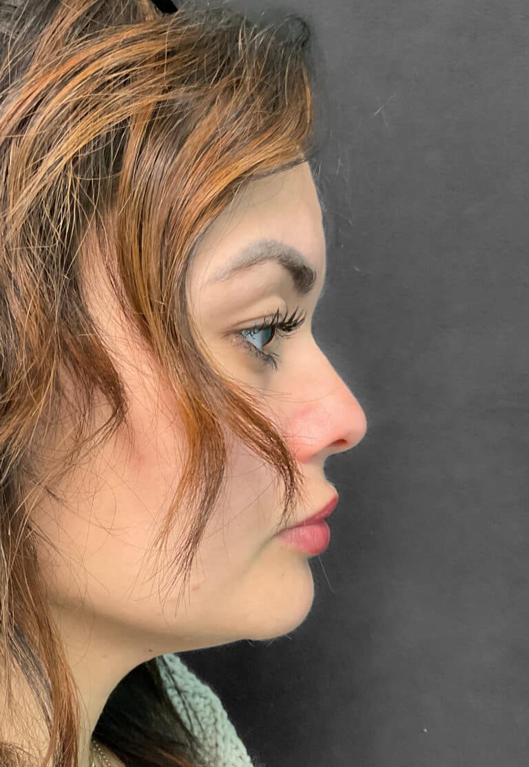 Before Image: Juvéderm Ultra & Voluma- Heather - right-side