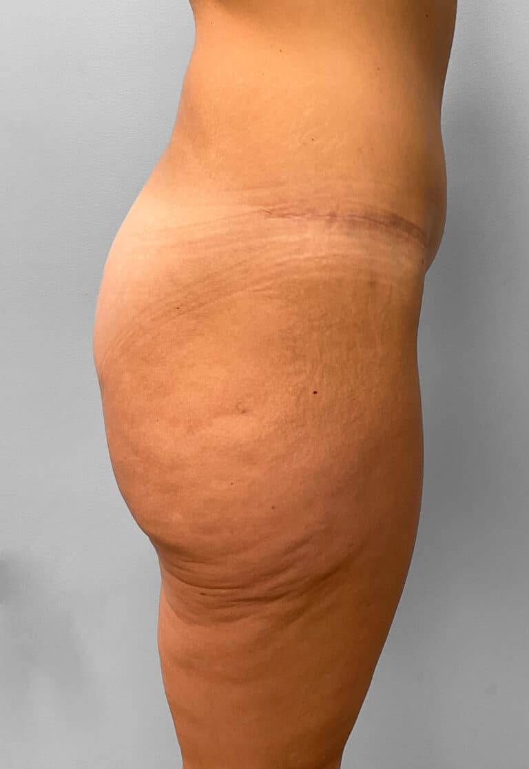 Before Image: Butt Lift- Dr. Howell - right-side