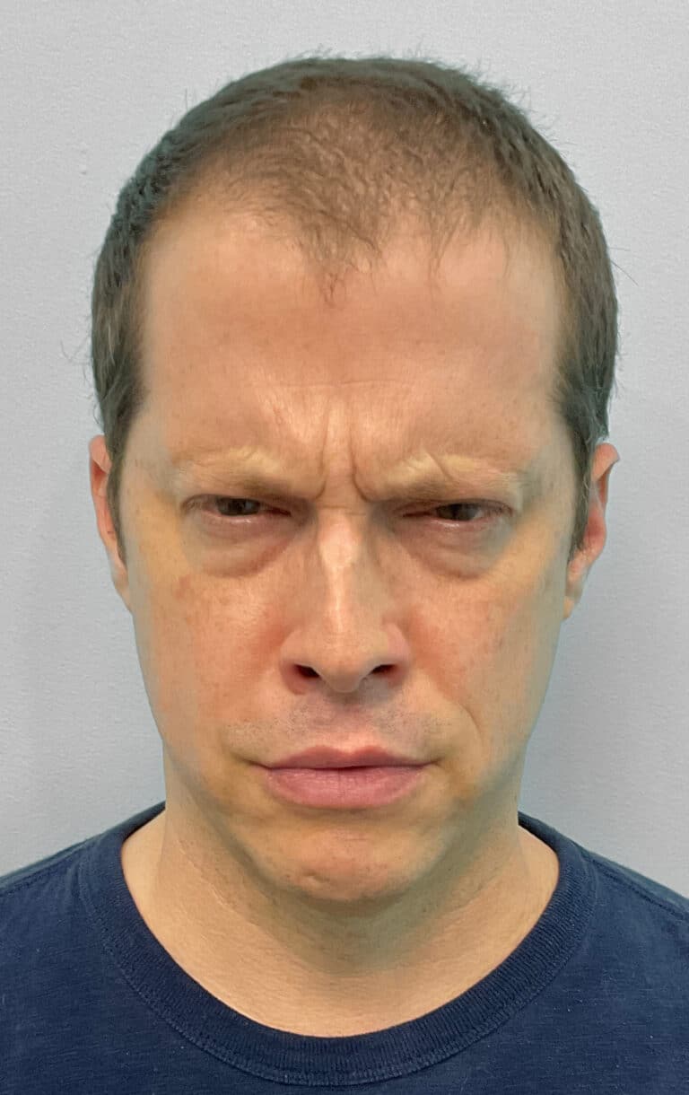Before Image: Botox- Joy -