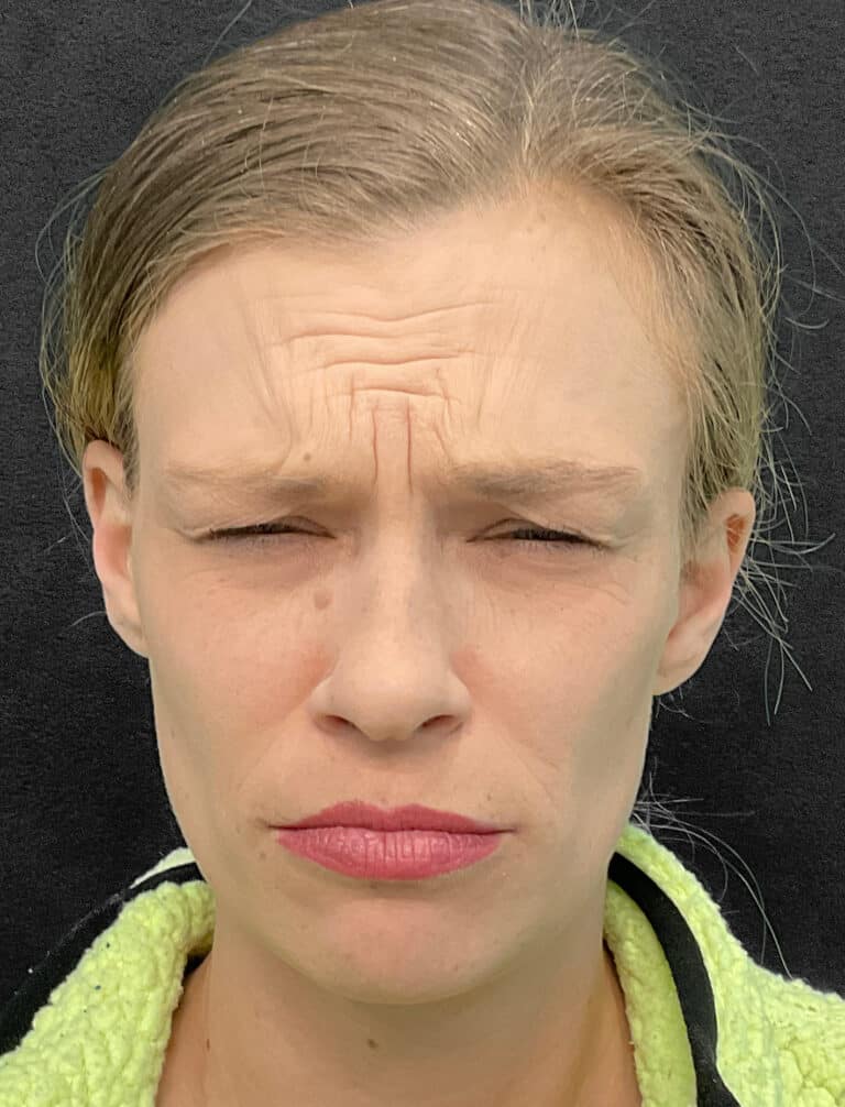 Before Image: Botox- Joy - front