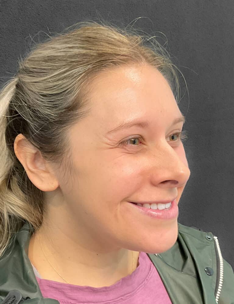 Before Image: Botox- Joy - right-front-oblique
