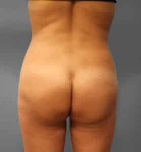 After Image: Lipo & BBL- Dr. Howell