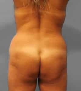 Before Image: Lipo & BBL- Dr. Howell