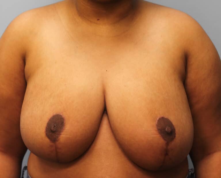 After Image: Breast Reduction – Dr. Howell - front