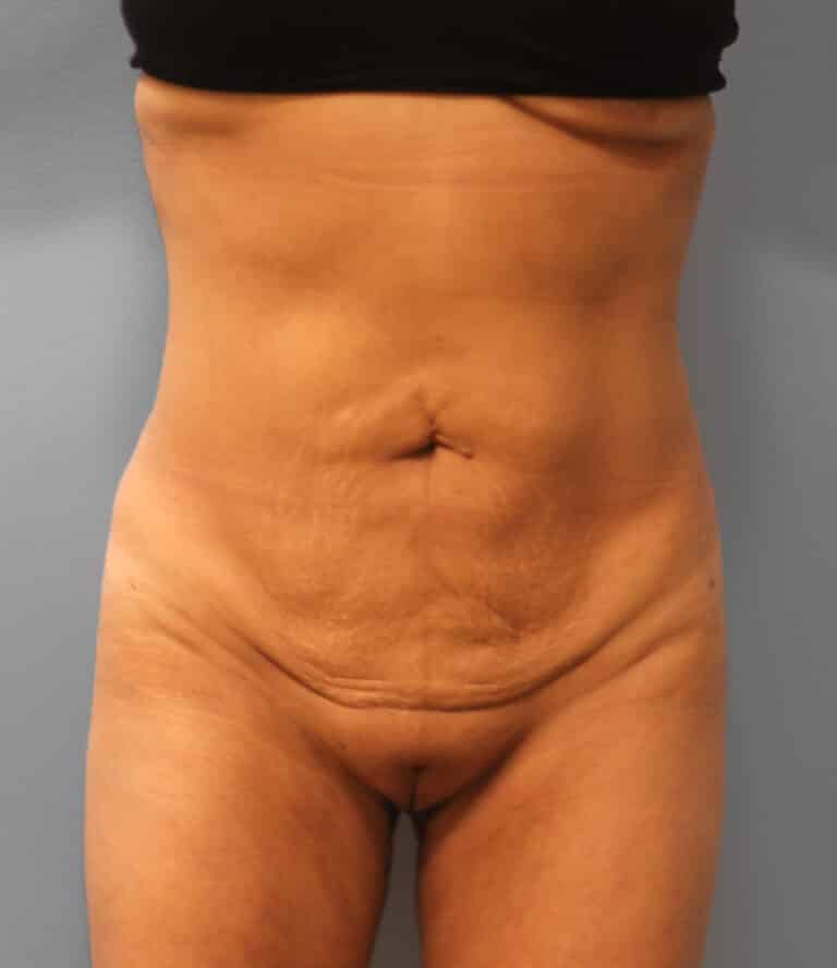 After Image: Lipo & BBL- Dr. Howell - front
