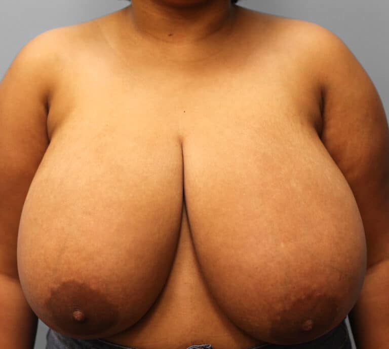 Before Image: Breast Reduction – Dr. Howell - front