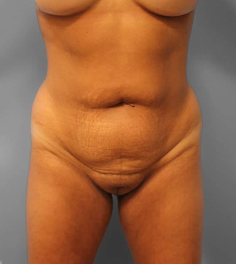 Before Image: Lipo & BBL- Dr. Howell - front