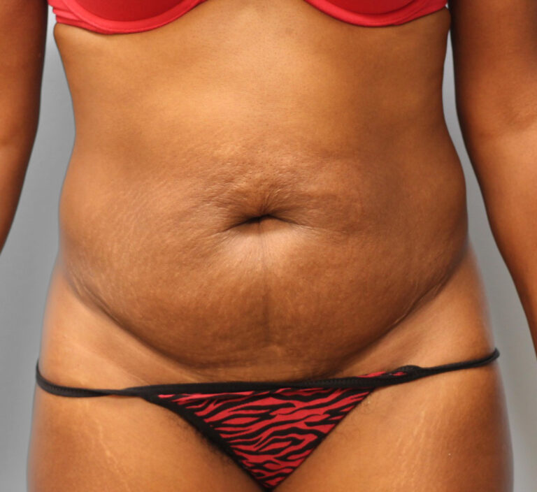 Before Image: Abdominoplasty (Tummy Tuck) – Dr. Howell - front