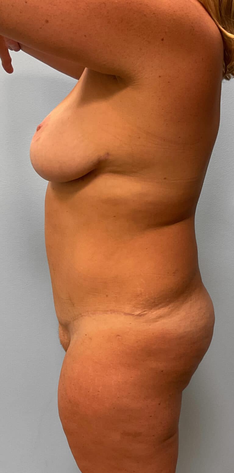 After Image: Mommy Makeover- Dr. Howell - left-side