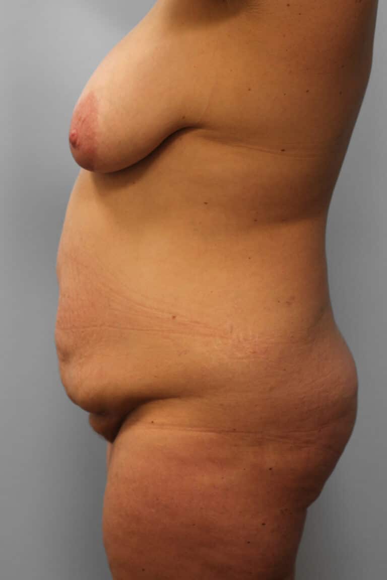 Before Image: Mommy Makeover- Dr. Howell - left-side