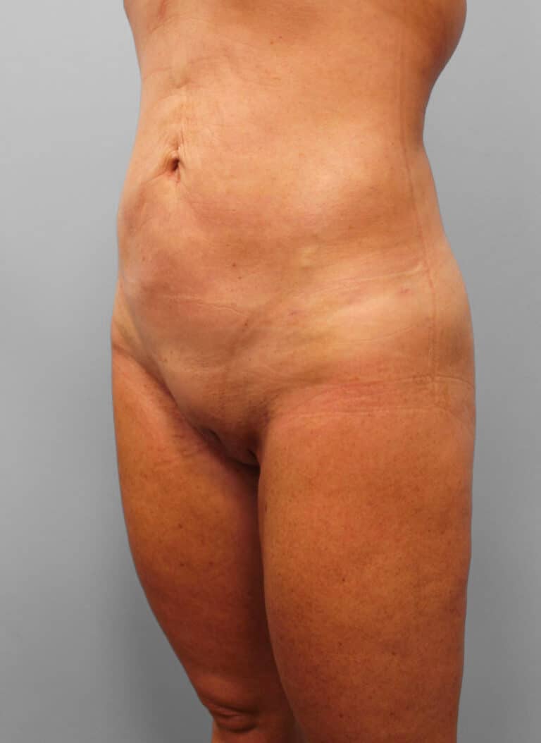 After Image: SmartLipo- Dr. Howell - left-front-oblique